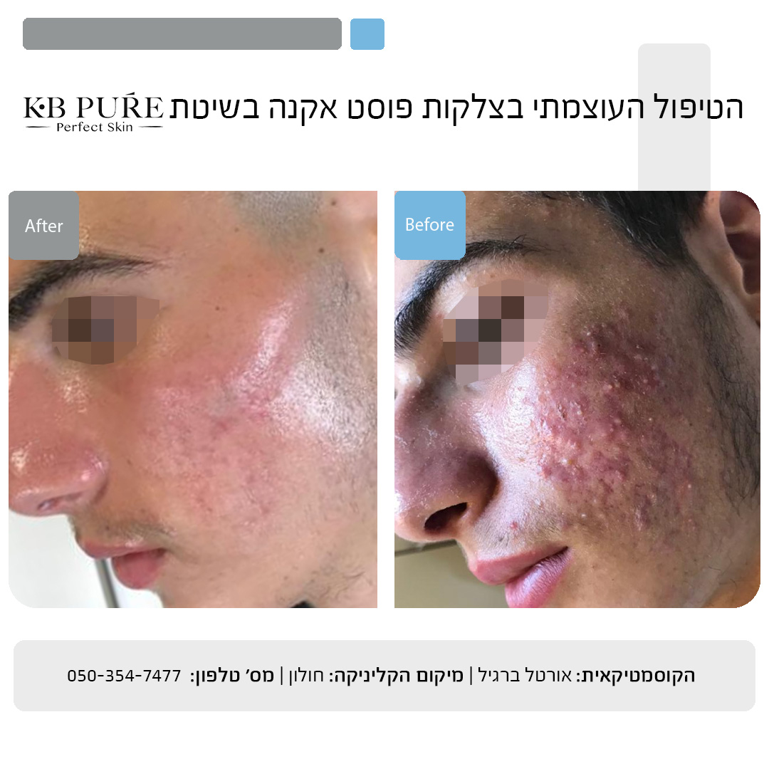 אורטל ברגיל חולון