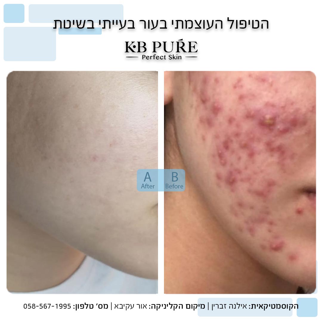 אילנה זברין אור עקיבא (1)