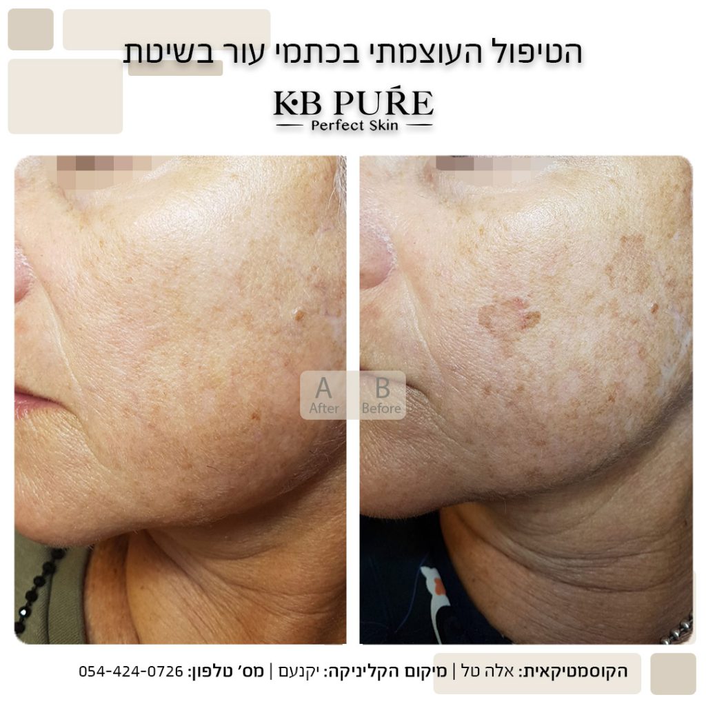 טיפול בכתמים בפנים