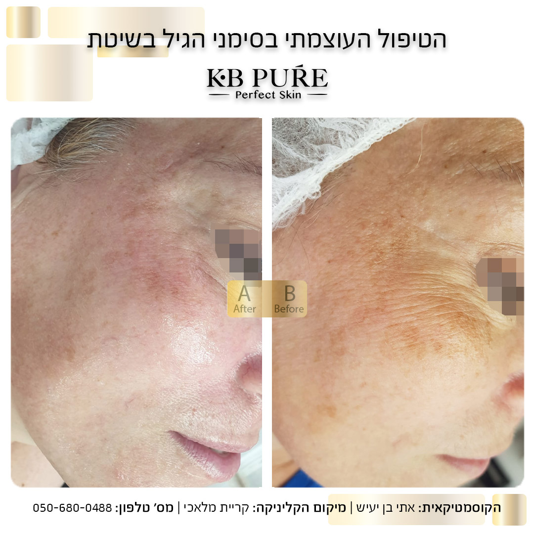 אתי בן יעיש קריית מלאכי - לפני ואחרי