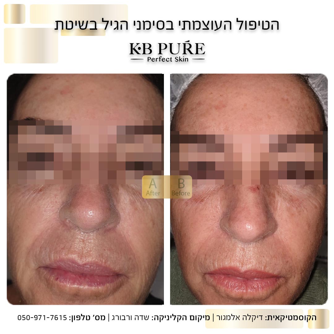 דיקלה אלמגור שדה ורבורג - לפני ואחרי