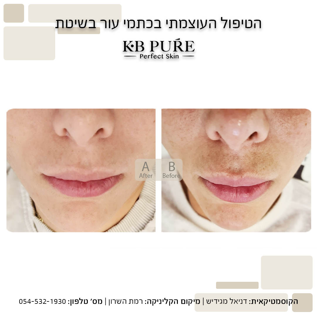 דניאל מגידיש רמת השרון (3) - לפני ואחרי