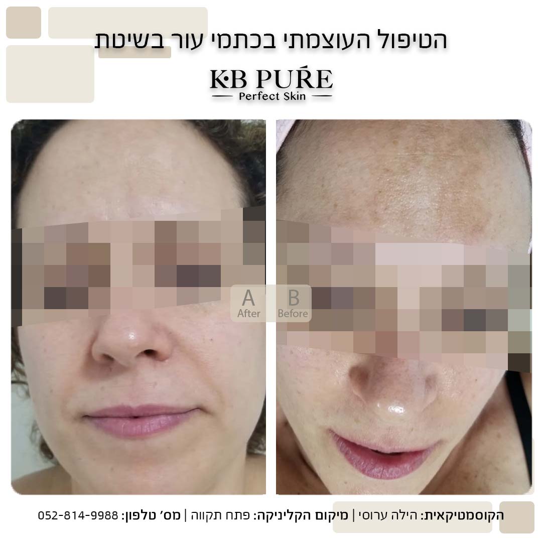 הילה ערוסי פתח תקווה (5) - לפני ואחרי