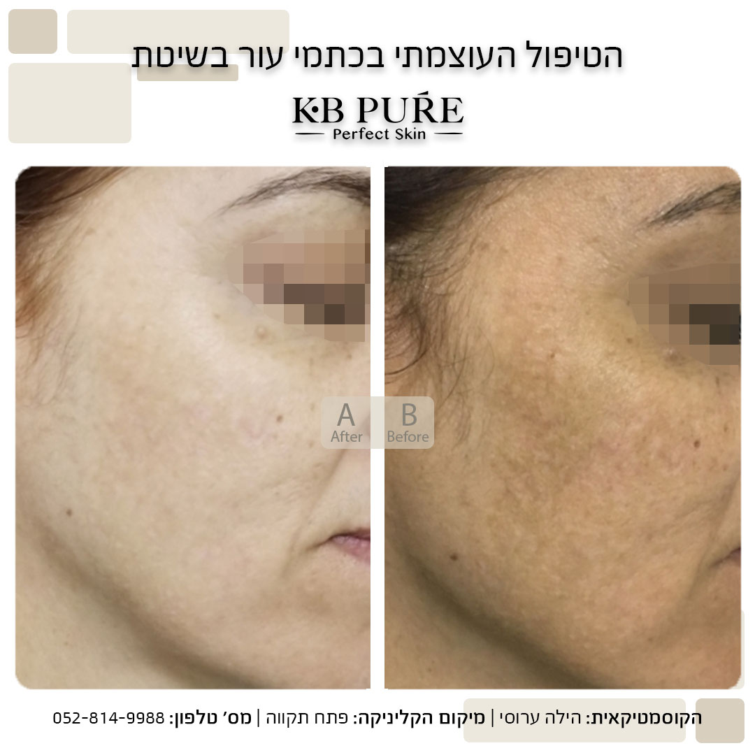 הילה ערוסי פתח תקווה - לפני ואחרי