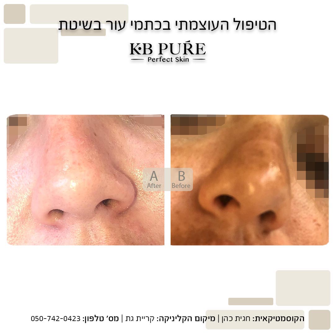 חגית כהן קריית גת (2) - לפני ואחרי