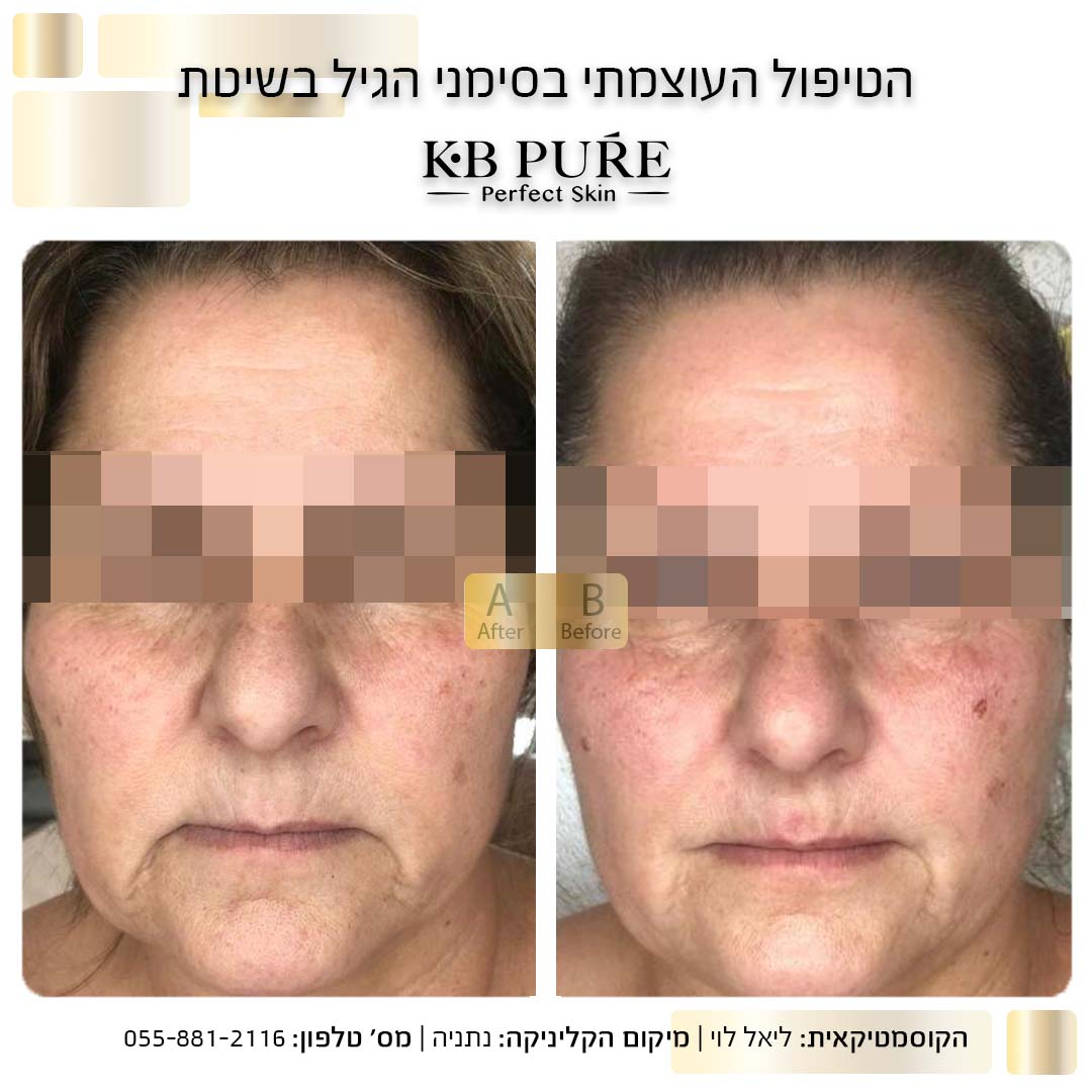 ליאל לוי נתניה (2) - לפני ואחרי