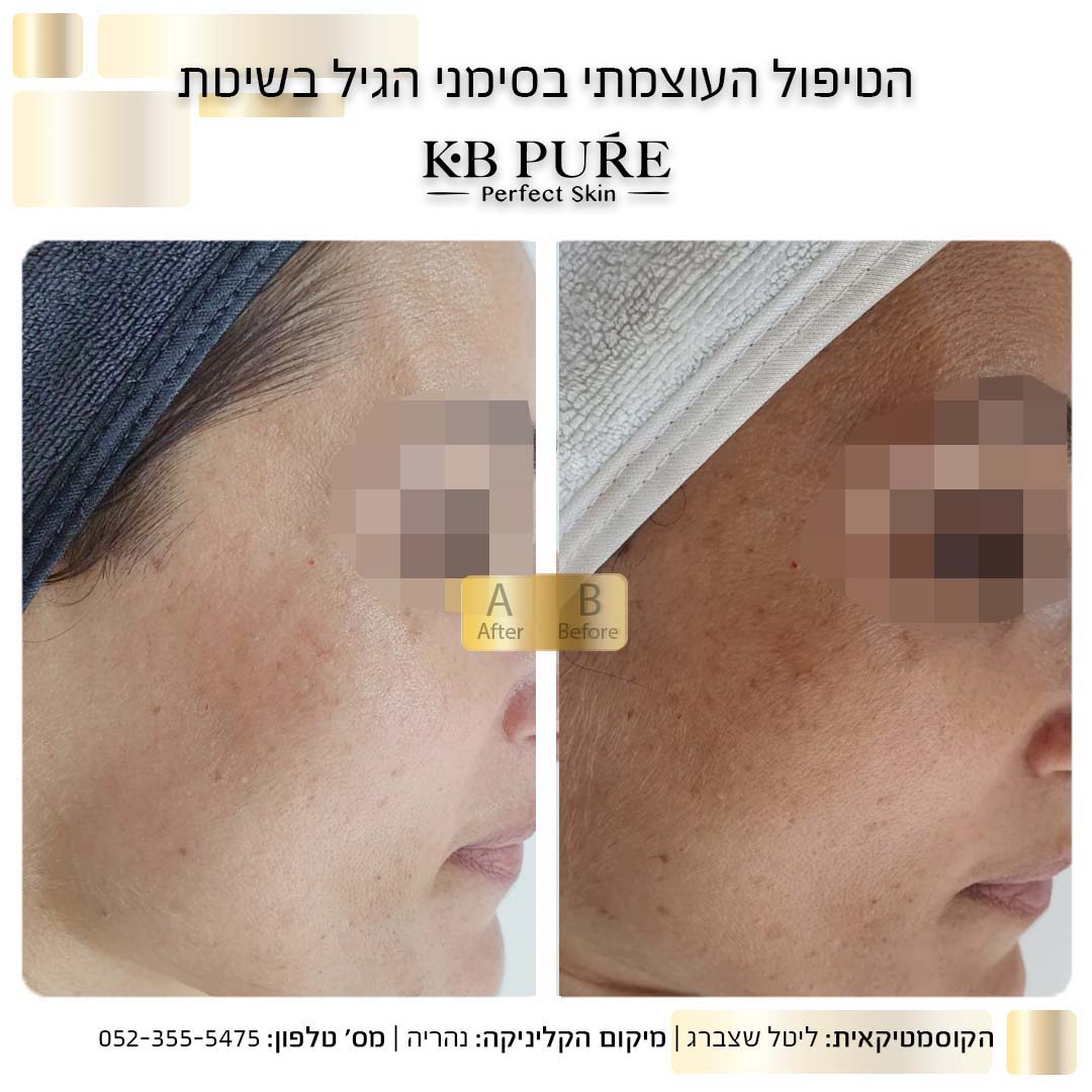 ליטל שצברג לפני ואחרי (4) - לפני ואחרי