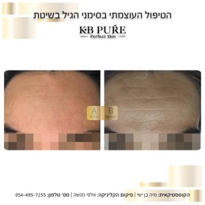 חומצה אזלאית