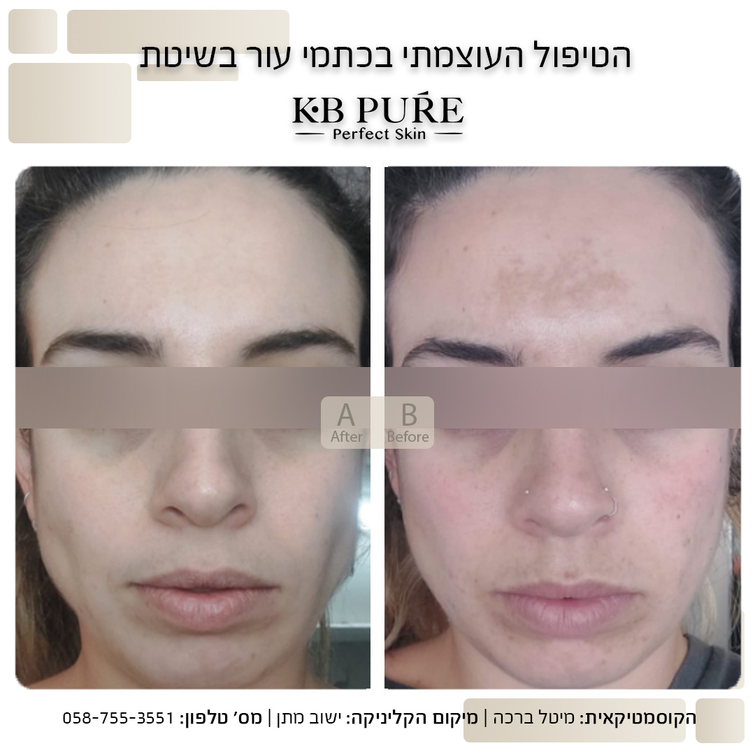 מיטל ברכה מתן