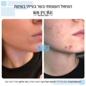 פצעים תת עוריים בפנים