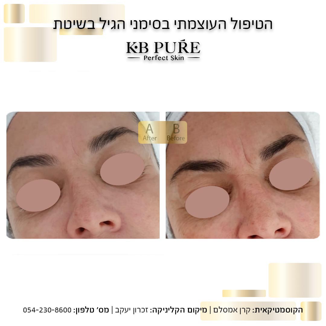קרן אמסלם זכרון יעקב 2 - לפני אחרי