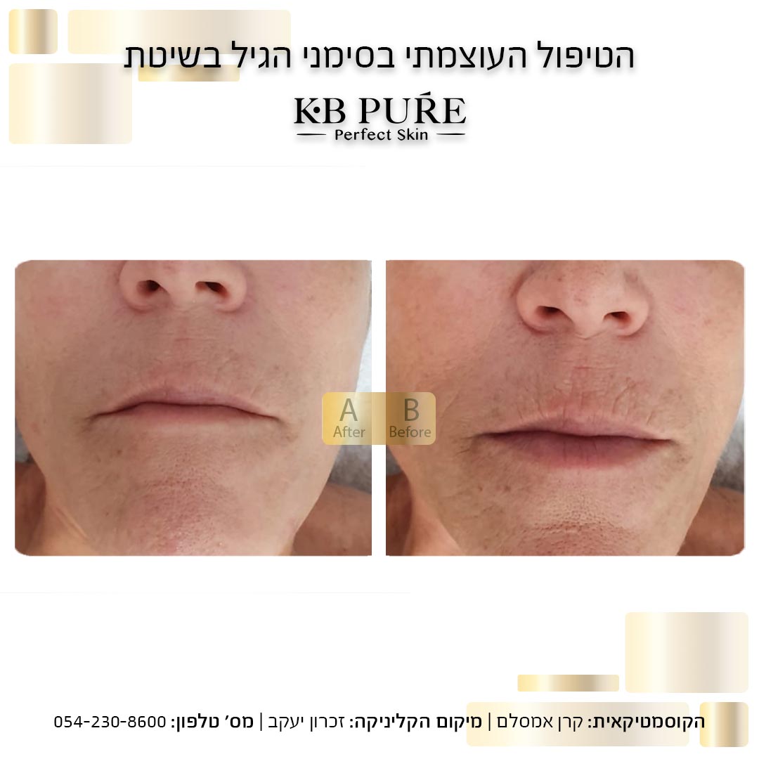 קרן אמסלם זכרון יעקב - לפני אחרי