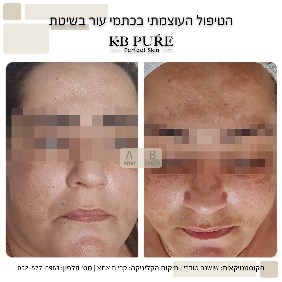 שושנה סודרי קריית אתא (2) - לפני ואחרי