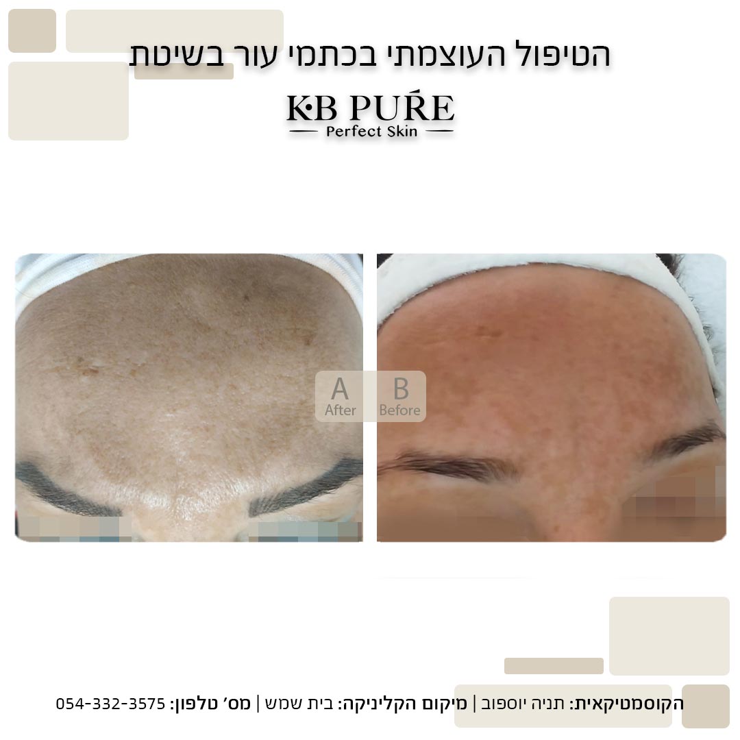 תניה יוספוב בית שמש (2) - לפני ואחרי