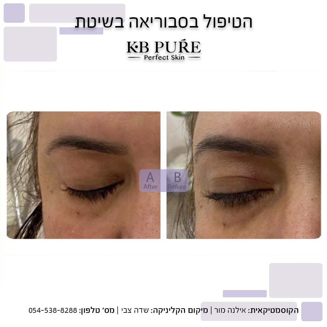 אילנית מור שדה צבי (4) - לפני ואחרי