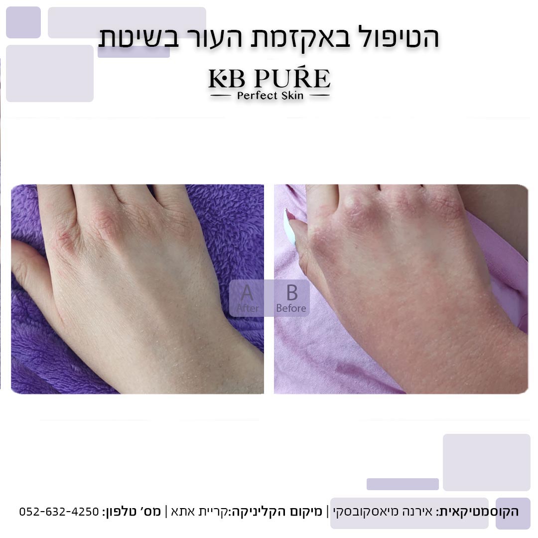 אירנה מיאסקובסקי קריית אתא (2) - לפני ואחרי