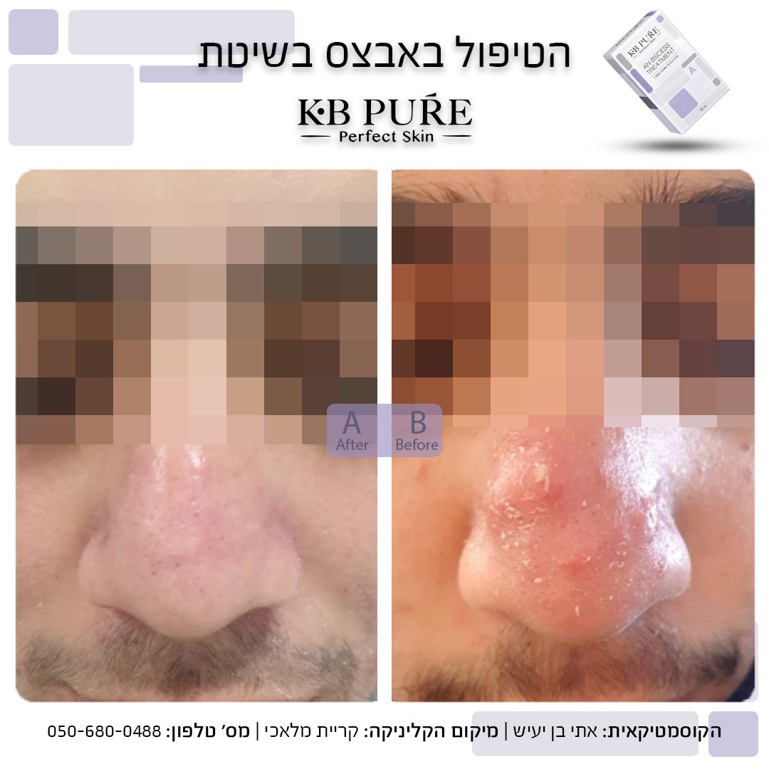 אתי בן יעיש קריית מלאכי (6) - לפני ואחרי