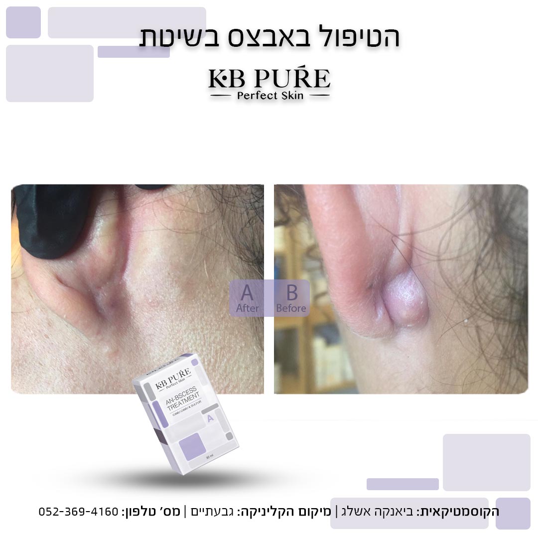 ביאנקה אשלג גבעתיים (2) - לפני ואחרי