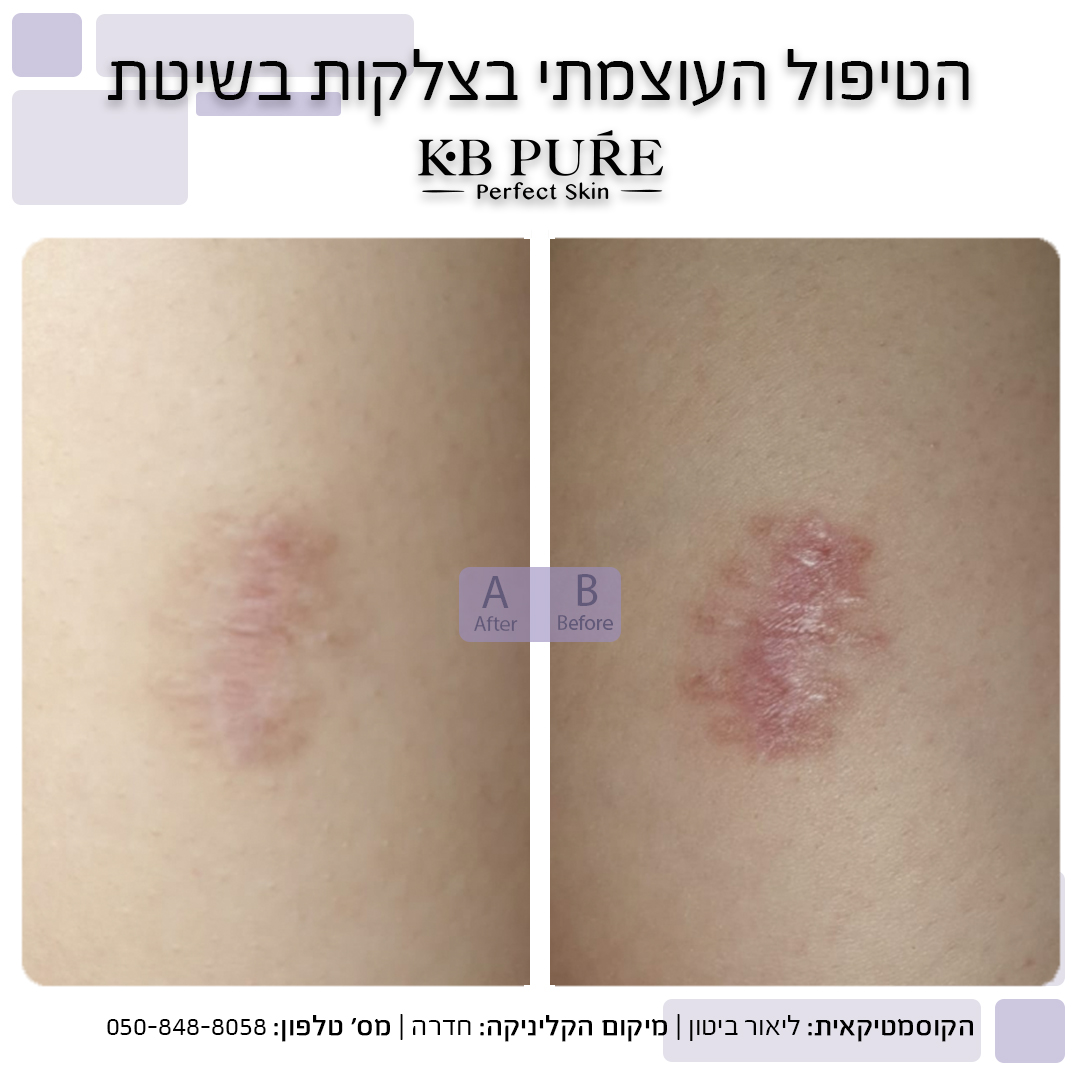 ליאור ביטון חדרה (6) - לפני ואחרי