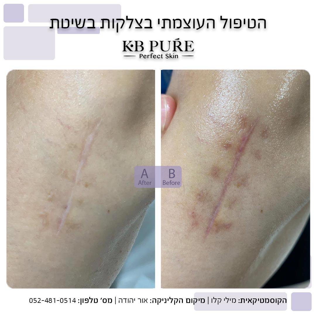 מילי קלו אור יהודה - לפני ואחרי