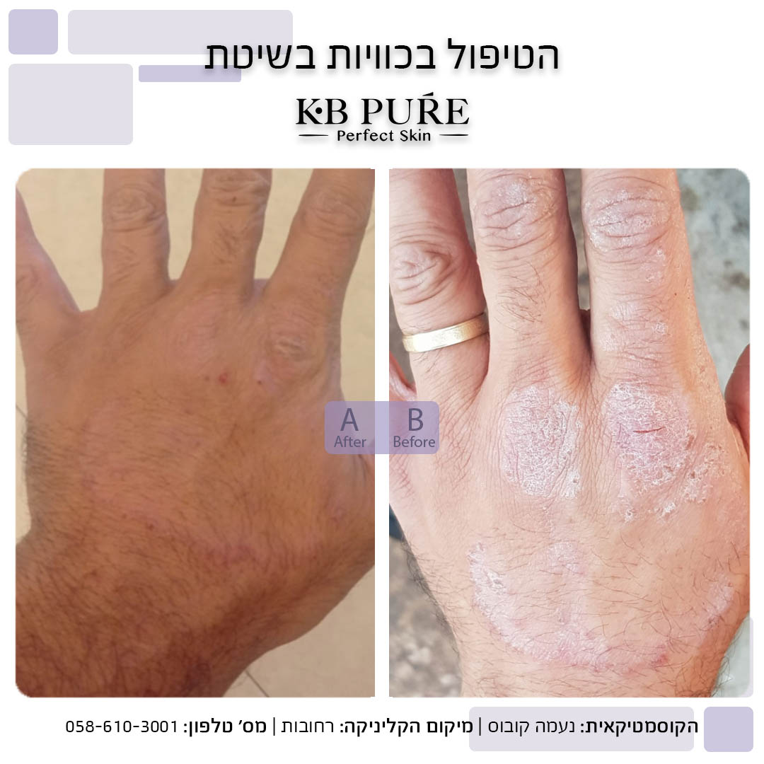 נעמה קובוס לפני ואחרי