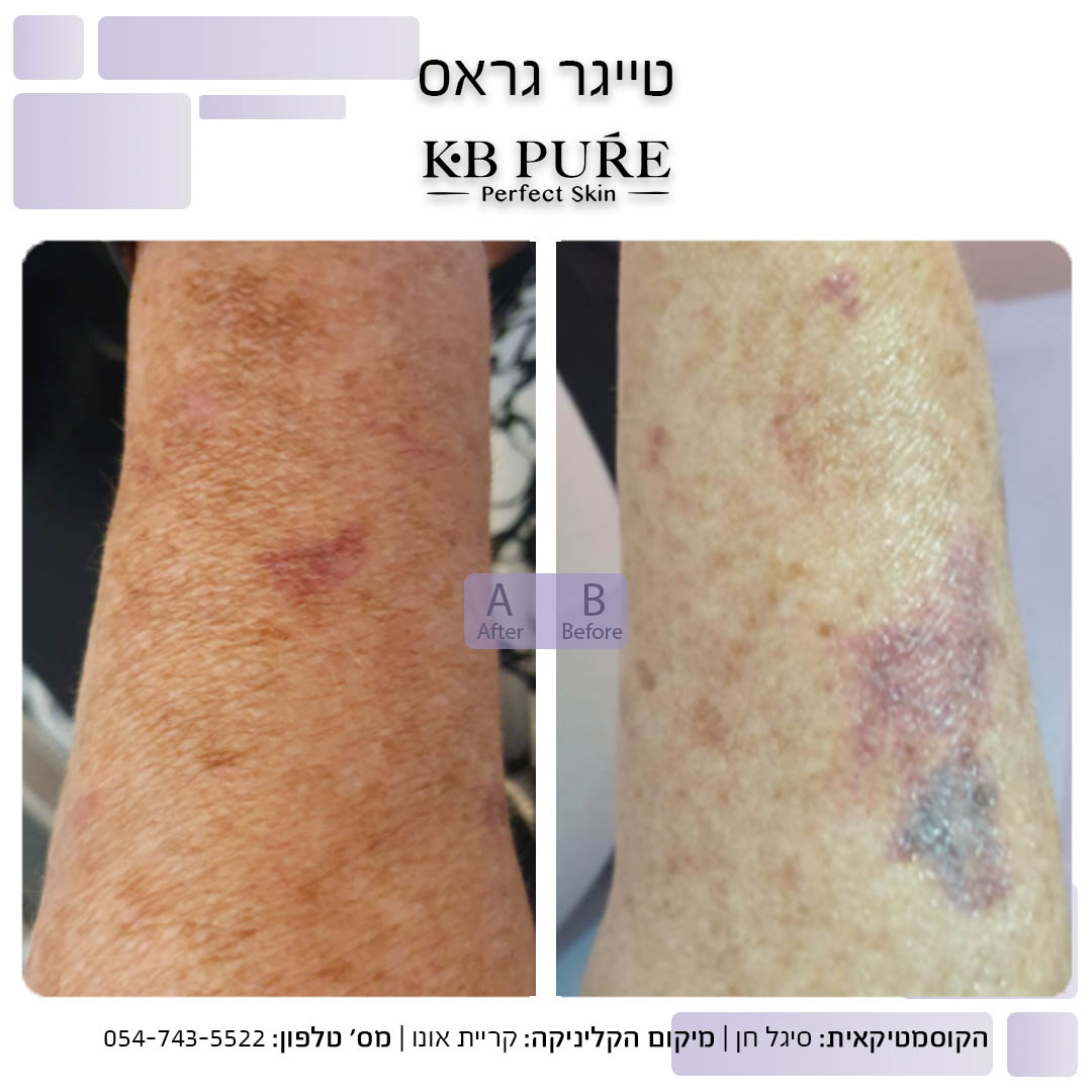 סיגל חן קריית אונו 3