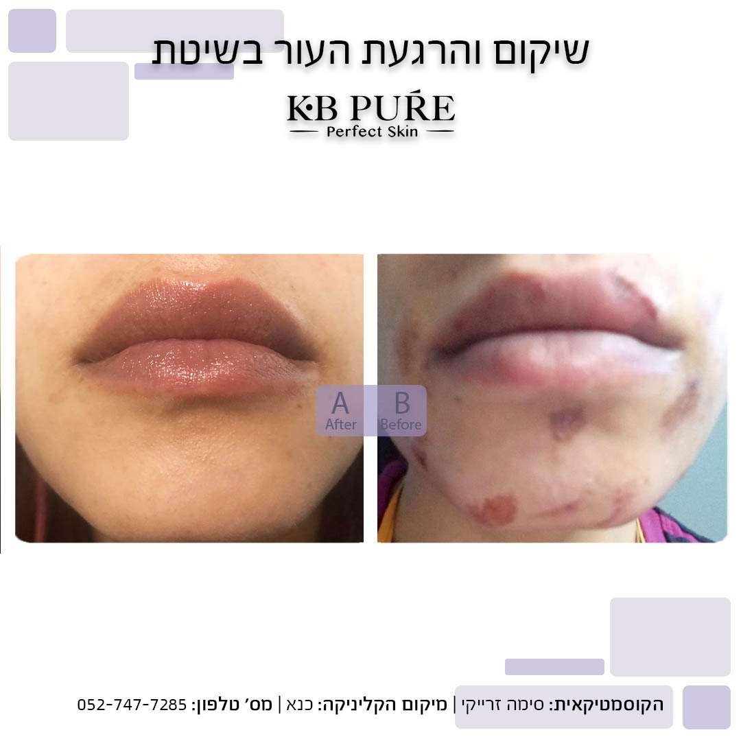 סימה סרייקי כנא (3) - לפני ואחרי