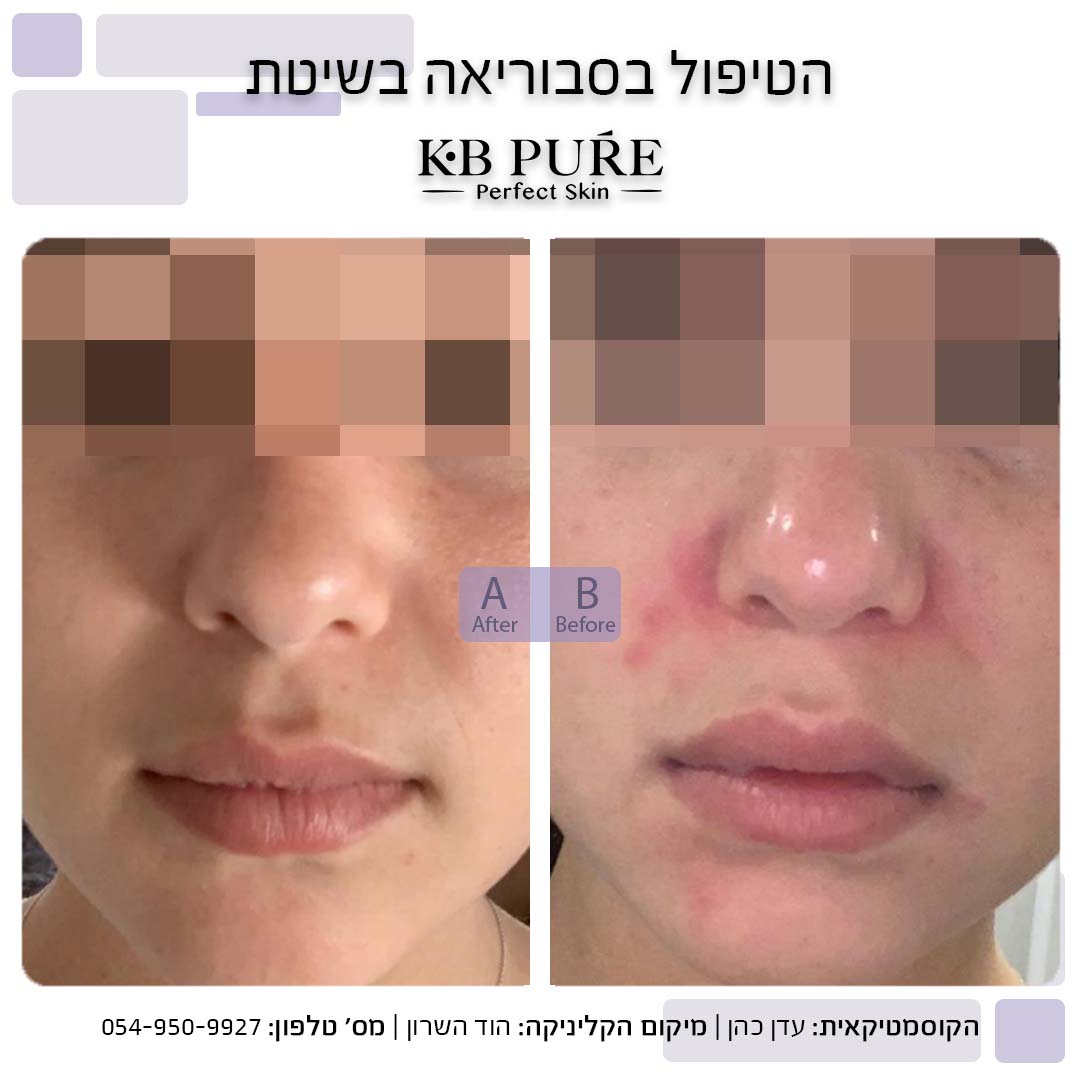 עדן כהן הוד השרון - לפני ואחרי